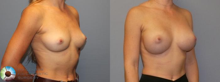Before & After Breast Augmentation Case 11996 Right Oblique in Denver and Colorado Springs, CO