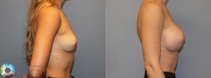 Before & After Breast Augmentation Case 11996 Right Side in Denver and Colorado Springs, CO
