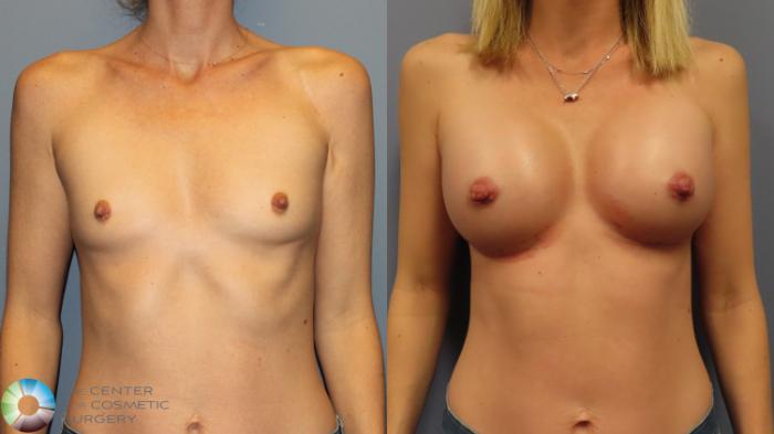 Before & After Breast Augmentation Case 12002 Front in Denver and Colorado Springs, CO