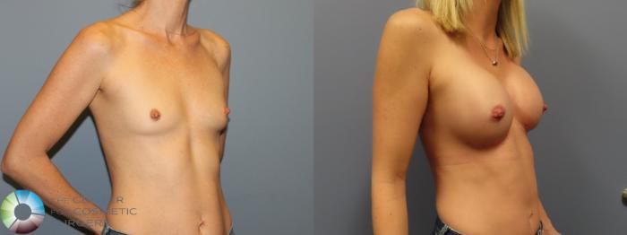 Before & After Breast Augmentation Case 12002 Right Oblique in Denver and Colorado Springs, CO