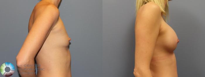 Before & After Breast Augmentation Case 12002 Right Side in Denver and Colorado Springs, CO