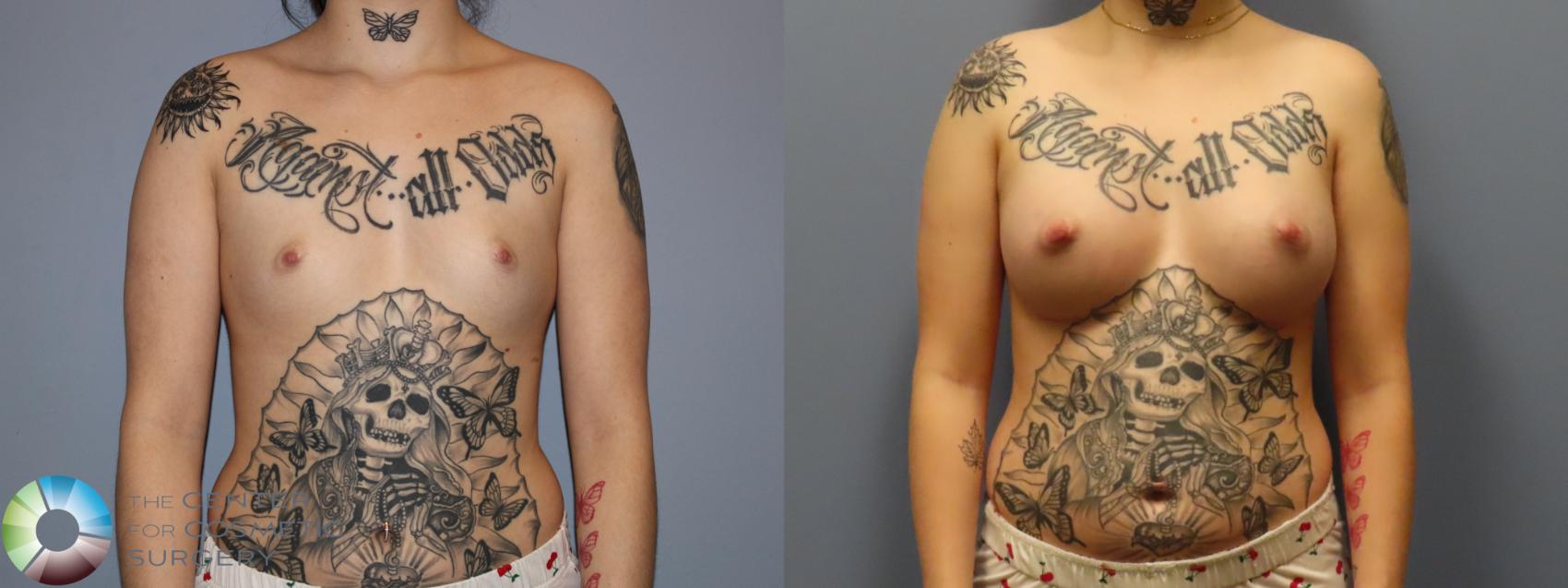 Before & After Breast Augmentation Case 12006 Front in Denver and Colorado Springs, CO