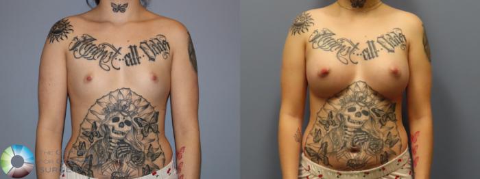 Before & After Breast Augmentation Case 12006 Front in Denver and Colorado Springs, CO