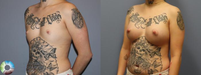 Before & After Breast Augmentation Case 12006 Left Oblique in Denver and Colorado Springs, CO