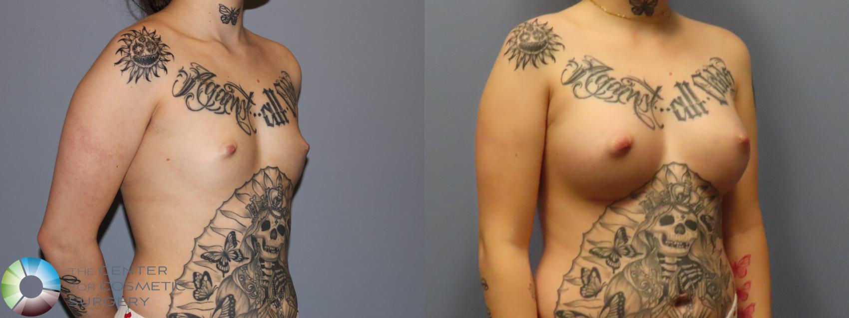 Before & After Breast Augmentation Case 12006 Right Oblique in Denver and Colorado Springs, CO