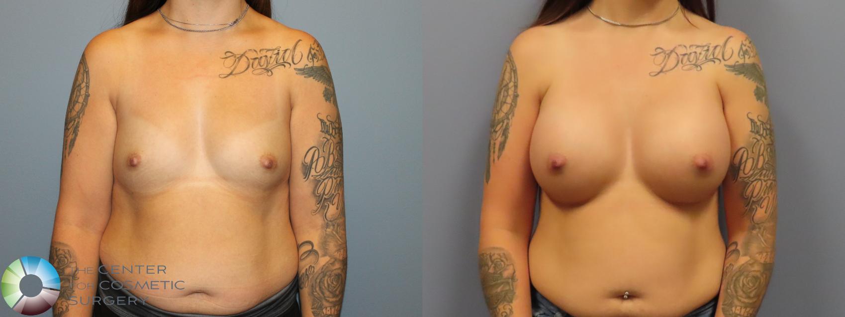 Before & After Breast Augmentation Case 12007 Front in Denver and Colorado Springs, CO