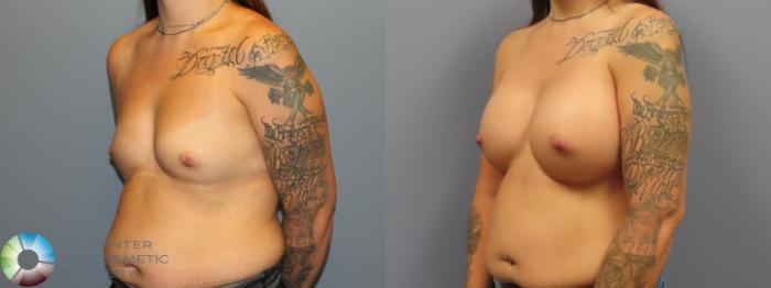 Before & After Breast Augmentation Case 12007 Left Oblique in Denver and Colorado Springs, CO