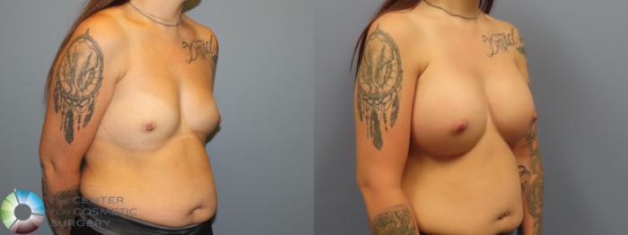 Before & After Breast Augmentation Case 12007 Right Oblique in Denver and Colorado Springs, CO