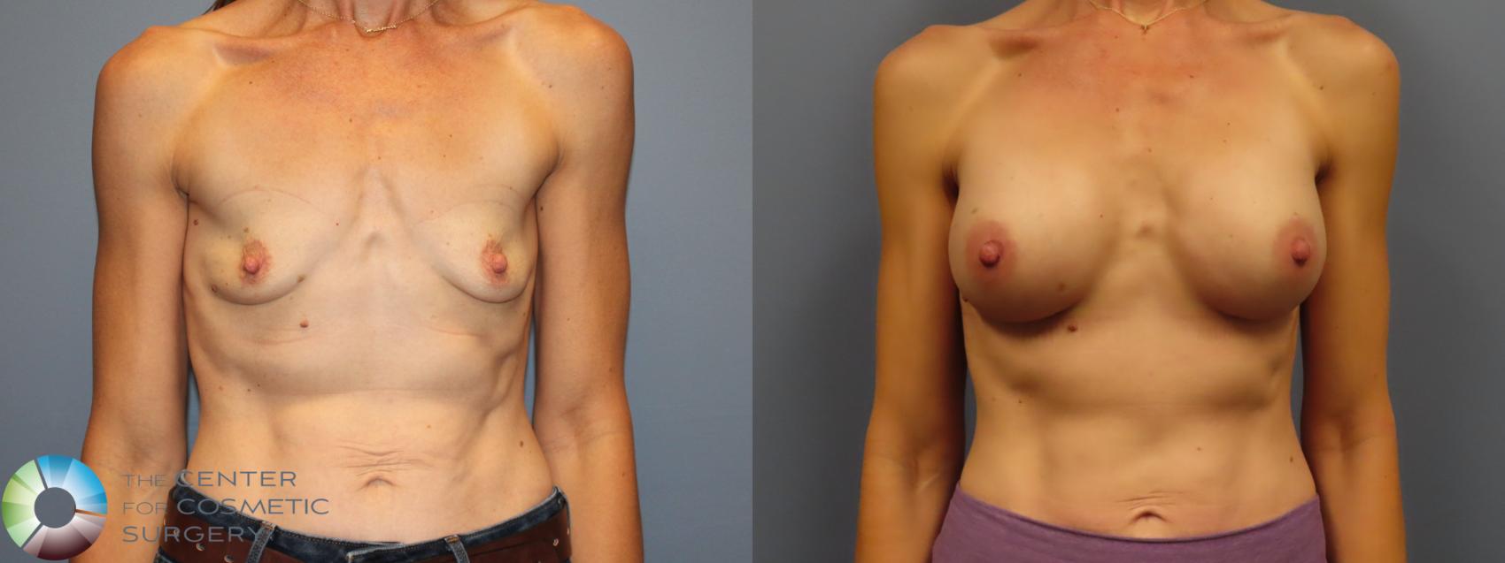 Before & After Breast Augmentation Case 12010 Front in Denver and Colorado Springs, CO