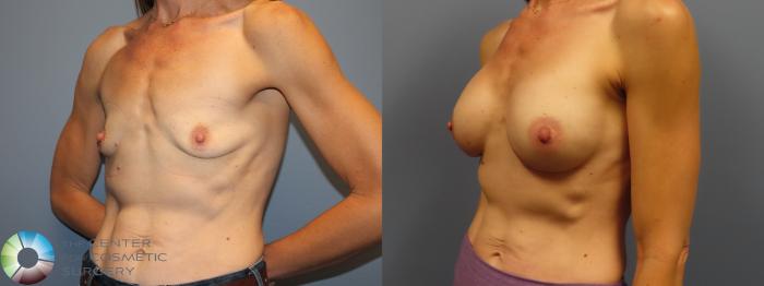 Before & After Breast Augmentation Case 12010 Left Oblique in Denver and Colorado Springs, CO