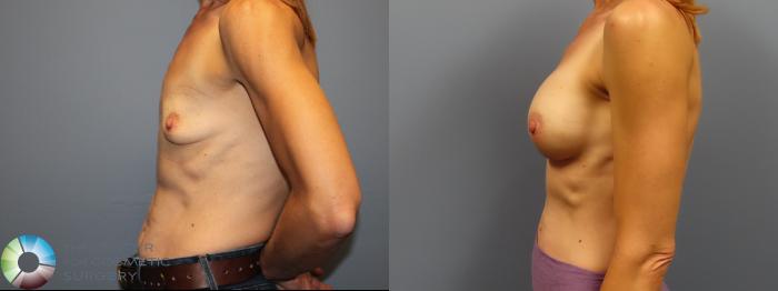 Before & After Breast Augmentation Case 12010 Left Side in Denver and Colorado Springs, CO