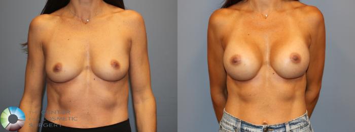 Before & After Breast Augmentation Case 12011 Front in Denver and Colorado Springs, CO