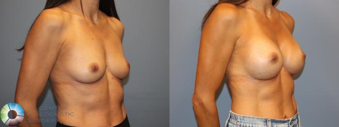 Before & After Breast Augmentation Case 12011 Right Oblique in Denver and Colorado Springs, CO