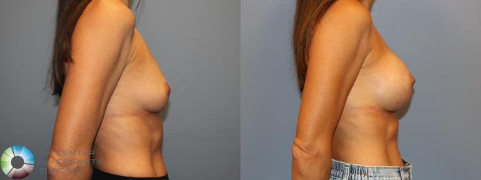 Before & After Breast Augmentation Case 12011 Right Side in Denver and Colorado Springs, CO