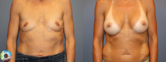 Before & After Breast Augmentation Case 12013 Front in Denver and Colorado Springs, CO