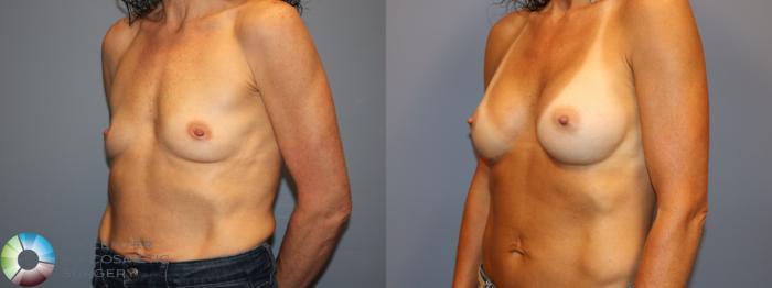 Before & After Breast Augmentation Case 12013 Left Oblique in Denver and Colorado Springs, CO