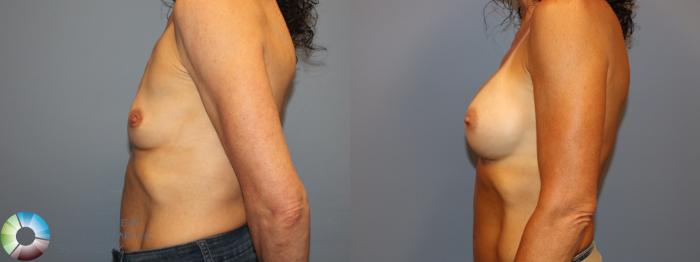 Before & After Breast Augmentation Case 12013 Left Side in Denver and Colorado Springs, CO