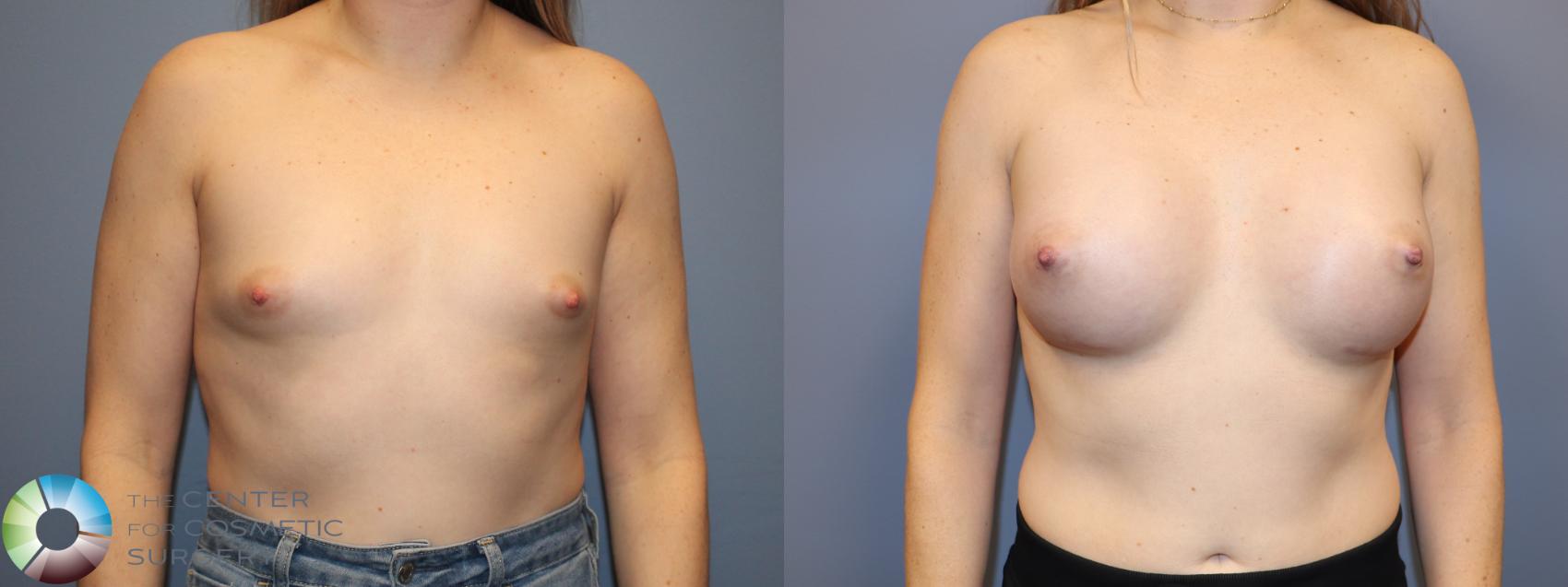 Before & After Breast Augmentation Case 12021 Front in Denver and Colorado Springs, CO