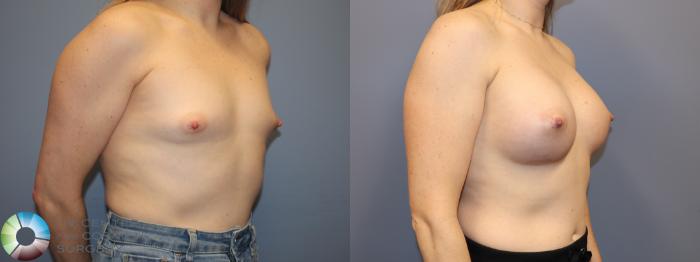 Before & After Breast Augmentation Case 12021 Right Oblique in Denver and Colorado Springs, CO