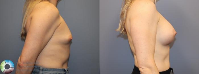 Before & After Breast Augmentation Case 12021 Right Side in Denver and Colorado Springs, CO