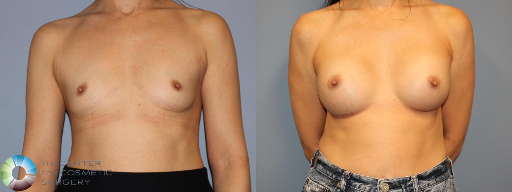 Before & After Breast Augmentation Case 12022 Front in Denver and Colorado Springs, CO