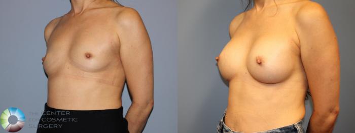 Before & After Breast Augmentation Case 12022 Left Oblique in Denver and Colorado Springs, CO