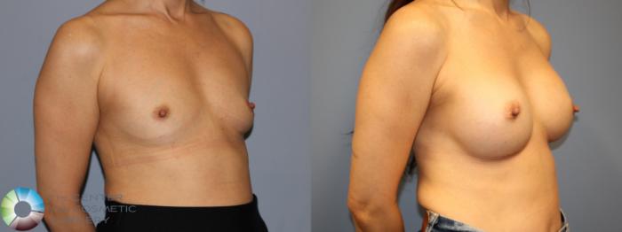 Before & After Breast Augmentation Case 12022 Right Oblique in Denver and Colorado Springs, CO