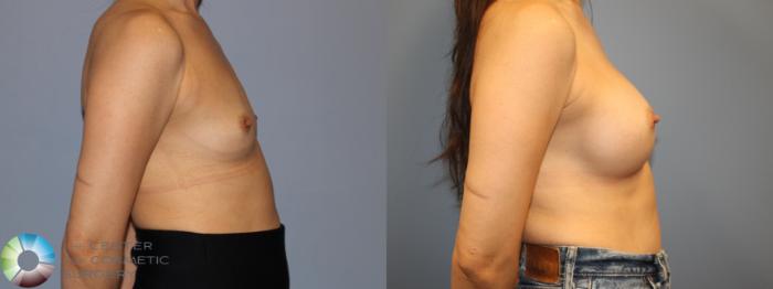 Before & After Breast Augmentation Case 12022 Right Side in Denver and Colorado Springs, CO