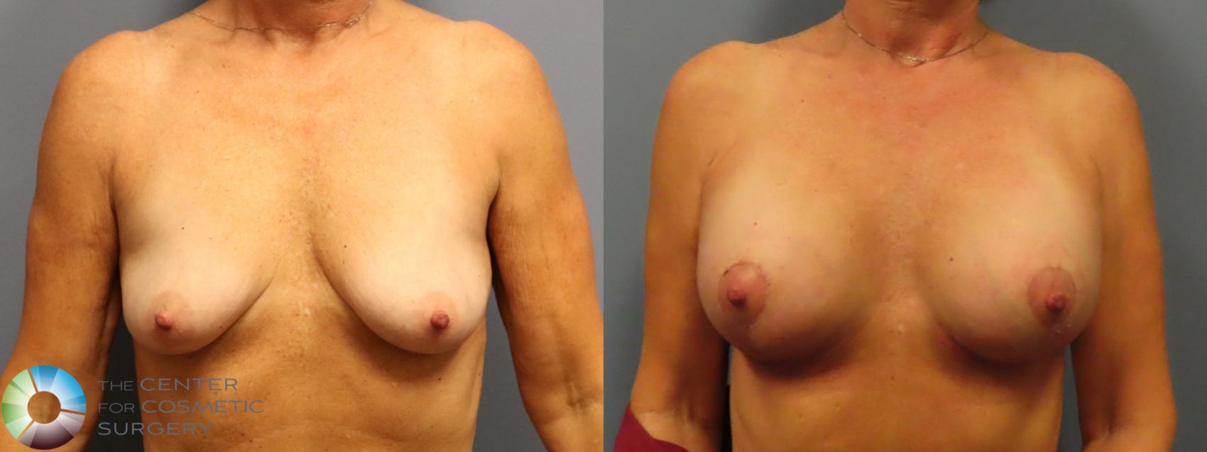 Best Denver Breast Implants Augmentation/Lift