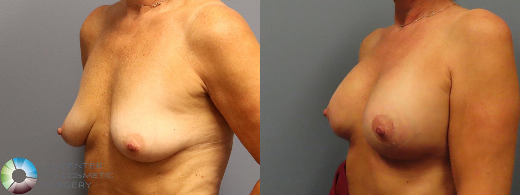 Before & After Breast Augmentation Case 12030 Left Oblique in Denver and Colorado Springs, CO