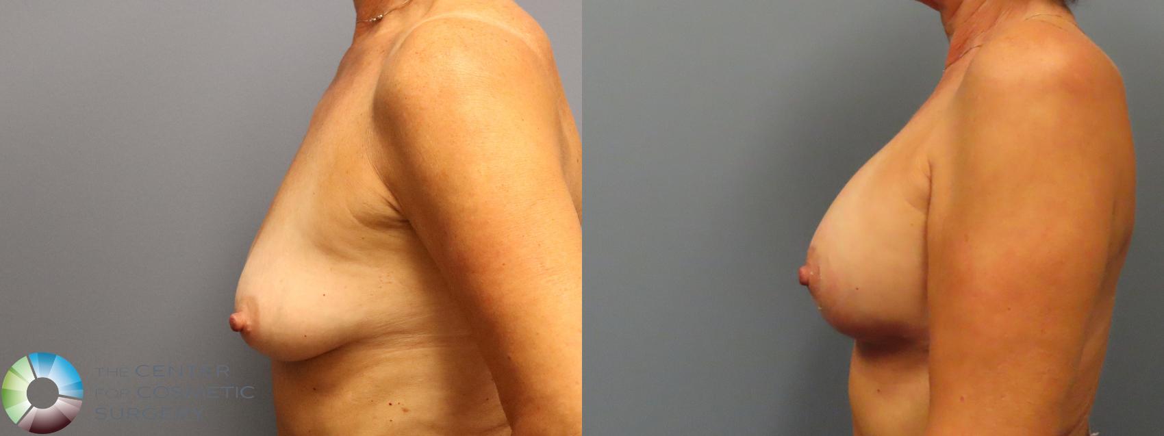 Before & After Breast Augmentation Case 12030 Left Side in Denver and Colorado Springs, CO