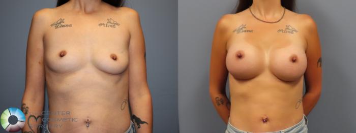 Before & After Breast Augmentation Case 12034 Front in Denver and Colorado Springs, CO