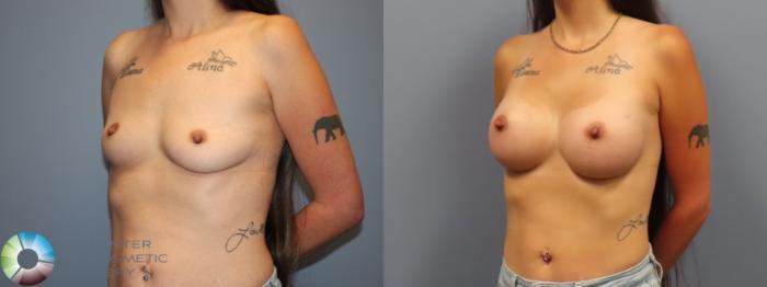 Before & After Breast Augmentation Case 12034 Left Oblique in Denver and Colorado Springs, CO