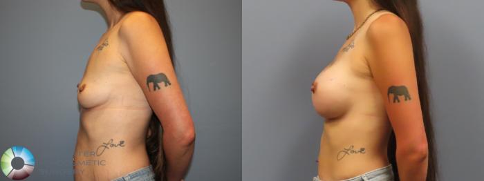 Before & After Breast Augmentation Case 12034 Left Side in Denver and Colorado Springs, CO