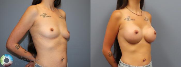 Before & After Breast Augmentation Case 12034 Right Oblique in Denver and Colorado Springs, CO