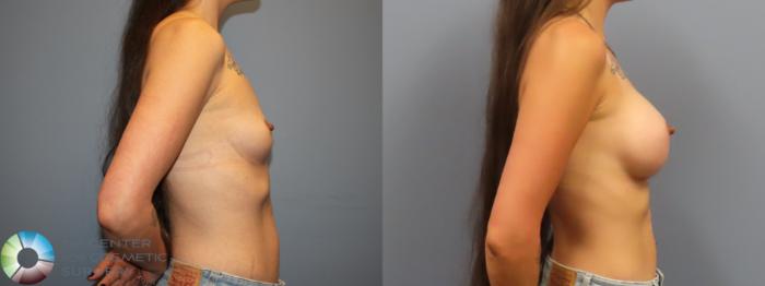 Before & After Breast Augmentation Case 12034 Right Side in Denver and Colorado Springs, CO