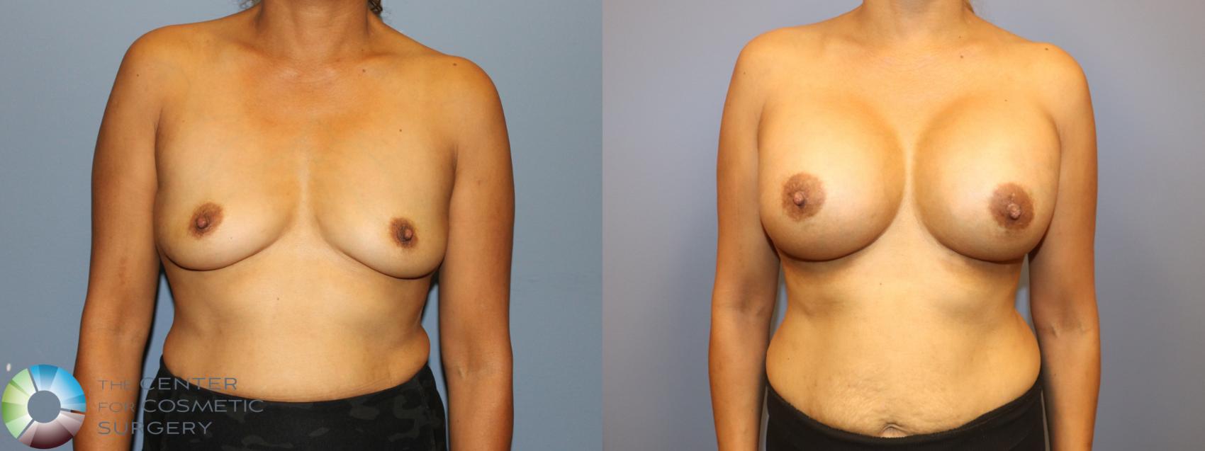 Before & After Breast Augmentation Case 12057 Front in Denver and Colorado Springs, CO