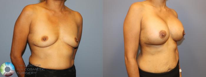 Before & After Breast Augmentation Case 12057 Right Oblique in Denver and Colorado Springs, CO