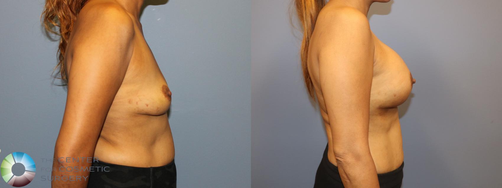 Before & After Breast Augmentation Case 12057 Right Side in Denver and Colorado Springs, CO