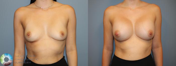 Before & After Breast Augmentation Case 12058 Front in Denver and Colorado Springs, CO