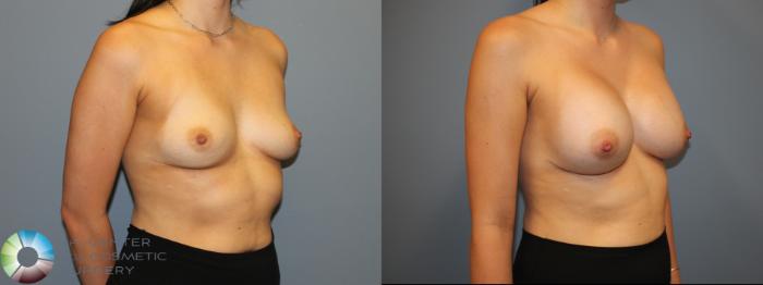 Before & After Breast Augmentation Case 12058 Right Oblique in Denver and Colorado Springs, CO