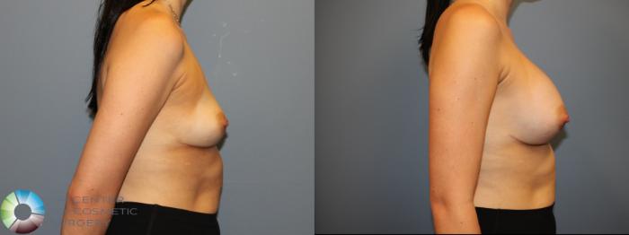 Before & After Breast Augmentation Case 12058 Right Side in Denver and Colorado Springs, CO