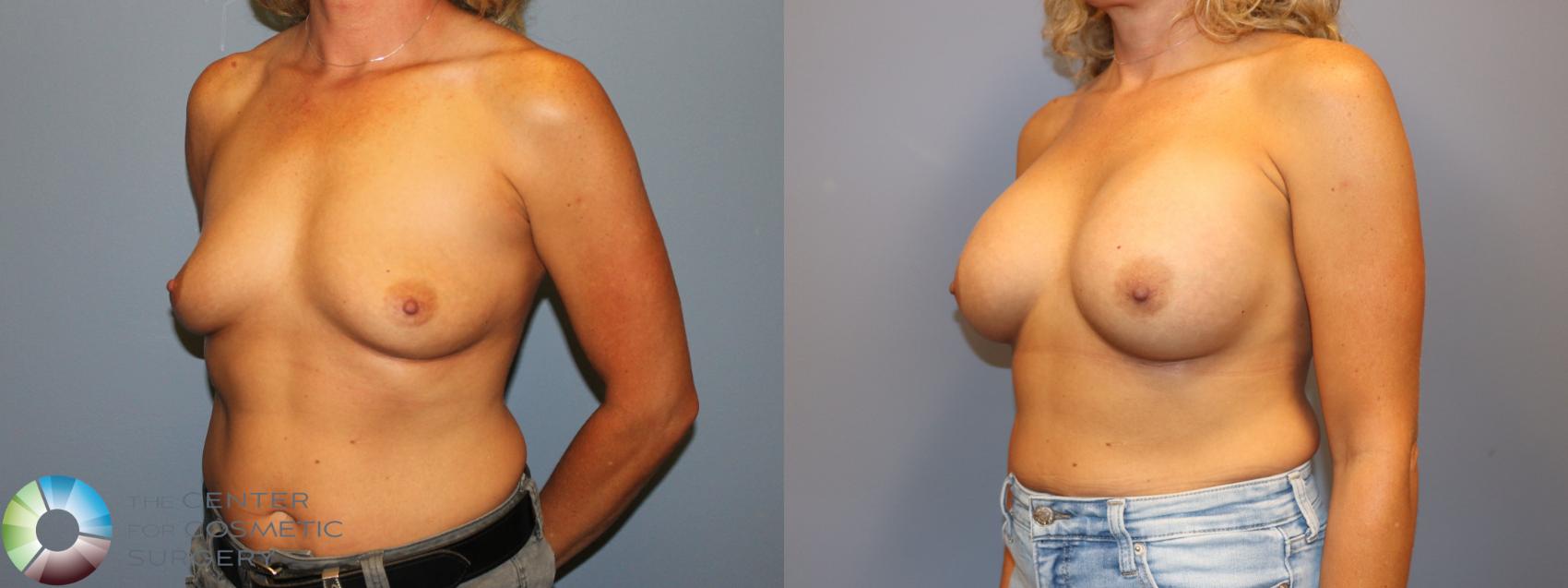 Before & After Breast Augmentation Case 12060 Left Oblique in Denver and Colorado Springs, CO