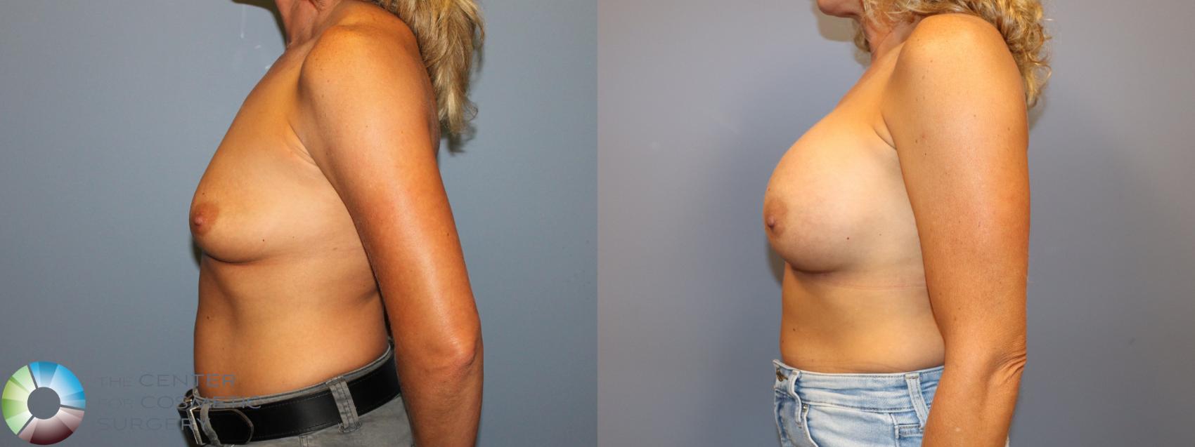 Before & After Breast Augmentation Case 12060 Left Side in Denver and Colorado Springs, CO