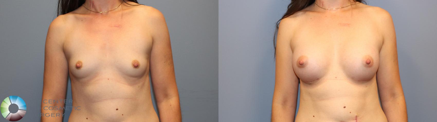 Before & After Breast Augmentation Case 12061 Front in Denver and Colorado Springs, CO