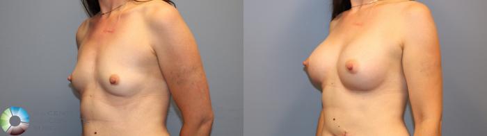 Before & After Breast Augmentation Case 12061 Left Oblique in Denver and Colorado Springs, CO