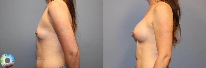 Before & After Breast Augmentation Case 12061 Left Side in Denver and Colorado Springs, CO