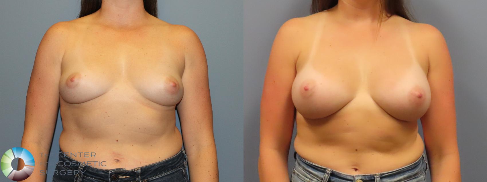 Before & After Breast Augmentation Case 12077 Front in Denver and Colorado Springs, CO