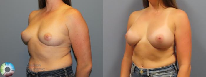 Before & After Breast Augmentation Case 12077 Left Oblique in Denver and Colorado Springs, CO