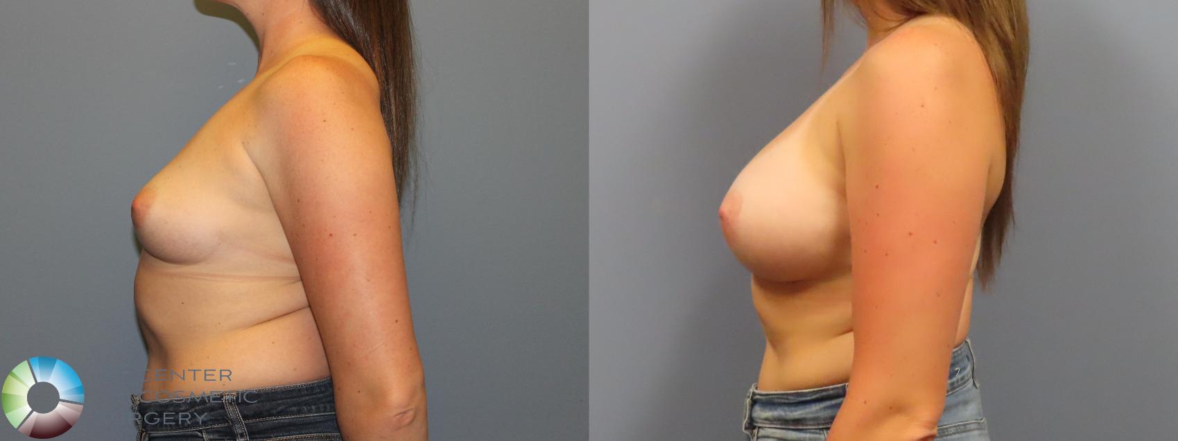 Before & After Breast Augmentation Case 12077 Left Side in Denver and Colorado Springs, CO